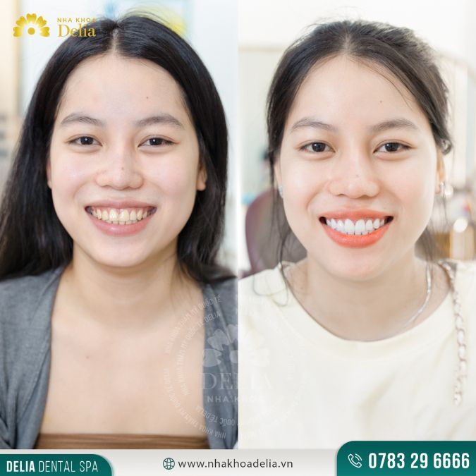 Tư vấn: Tẩy trắng răng có đau không? Có ê buốt, khó chịu không?