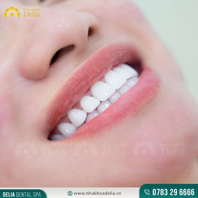 Tẩy trắng răng có làm răng yếu đi? Có hại cho sức khỏe không?