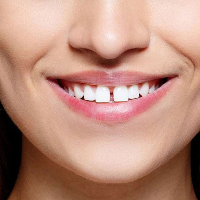 Trám kẽ hở giữa 2 răng bao nhiêu tiền, làm ở đâu uy tín, chất lượng?