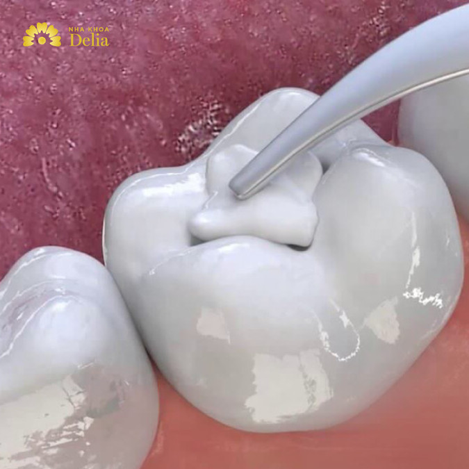 Trám răng cấm bao nhiêu tiền? Trám ở đâu uy tín, chất lượng?