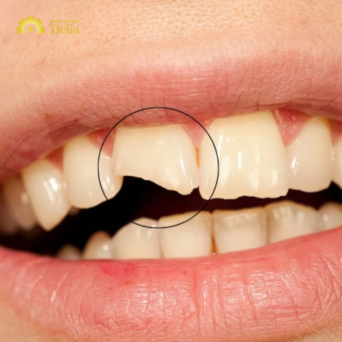Trám răng cửa bao nhiêu tiền, có nên trám răng cửa không?