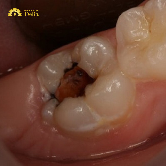 Trám răng hàm bị sâu, vỡ như thế nào, có đau không?