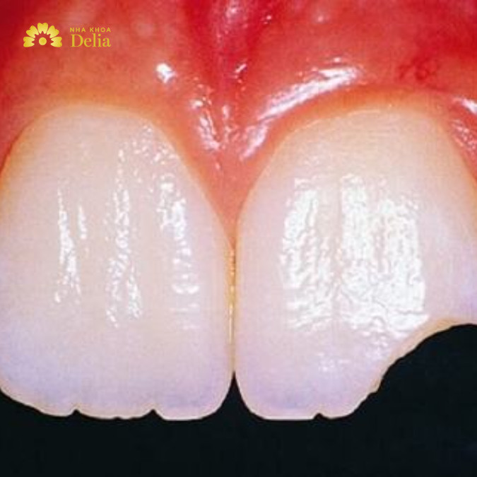 Trám răng mẻ như thế nào, hết bao nhiêu tiền?