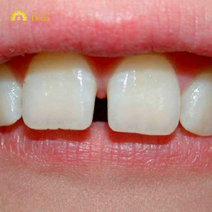 Trám răng thưa có bền không, có nên trám kẽ răng thưa không?