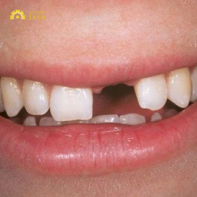 40 tuổi rụng răng phải làm sao? Có cần trồng răng ngay không?