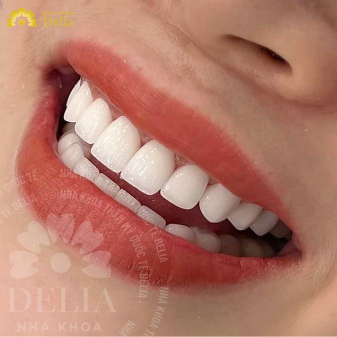 Bạn có hợp dáng răng sứ dáng vuông? Làm răng sứ dáng vuông ở đâu?