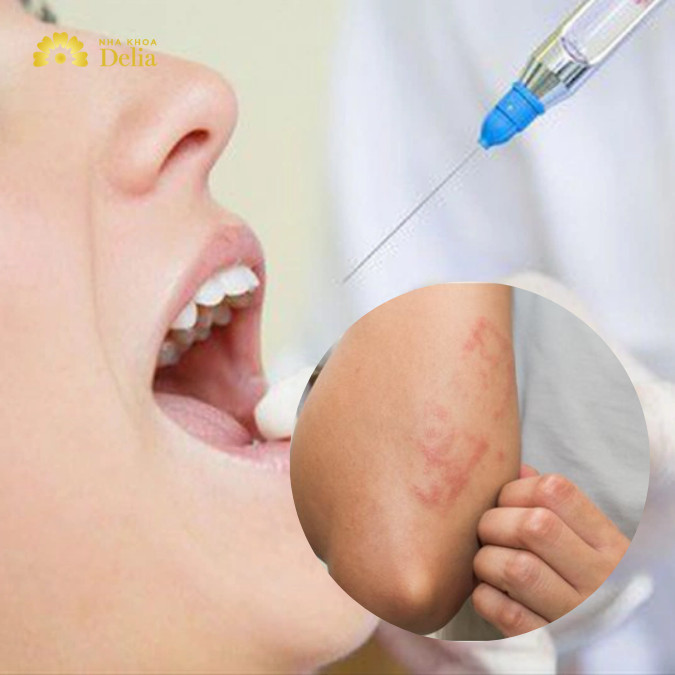 Dị ứng thuốc tê nhổ răng – Triệu chứng, nguyên nhân và cách xử lý hiệu quả