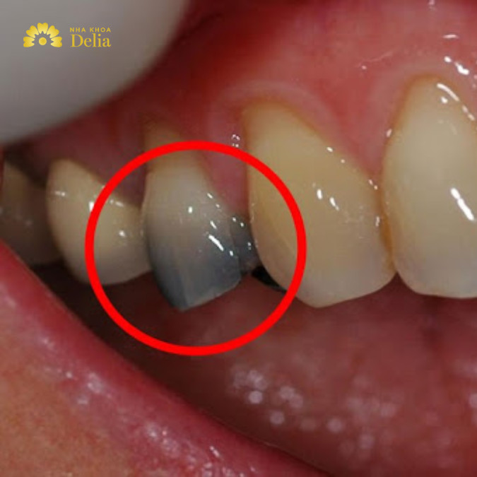 Khi nào cần lấy tủy răng, quy trình lấy tủy răng như thế nào?