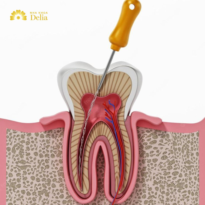 Lấy tủy răng có đau không? Quy trình lấy tủy như thế nào?