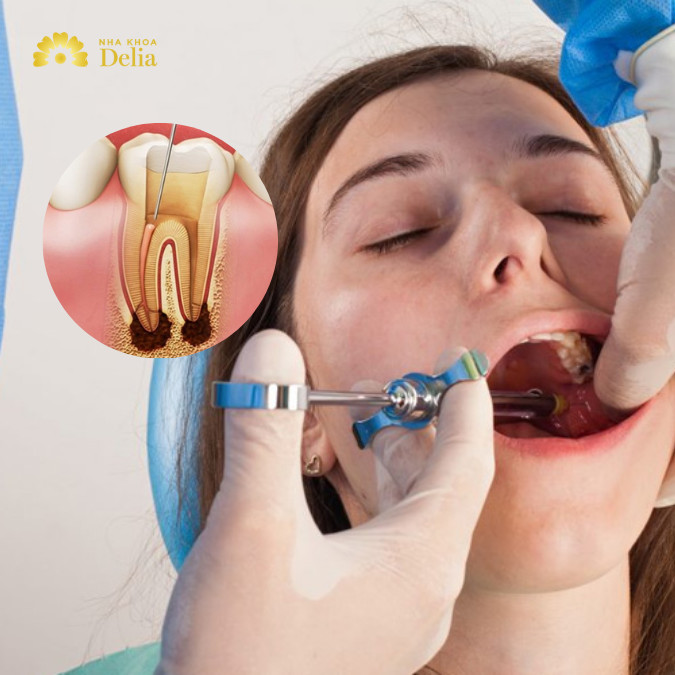 Lấy tủy răng có tiêm thuốc tê không? Giải đáp chi tiết từ chuyên gia