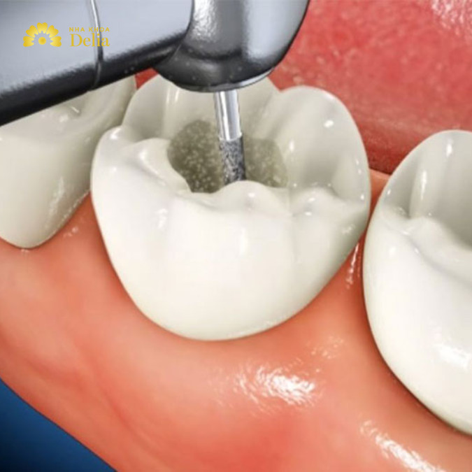Lấy tủy răng mất bao lâu, quy trình như thế nào?