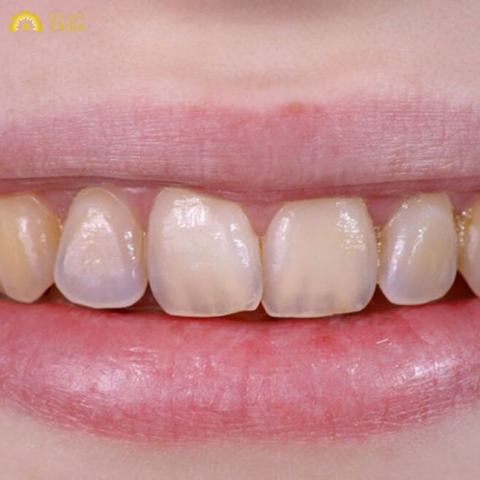 Mòn răng phải làm sao? Đâu là giải pháp tốt nhất