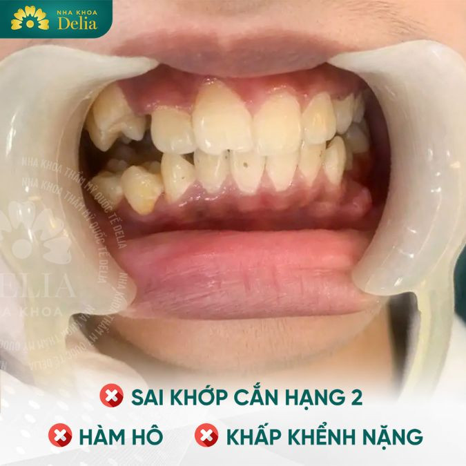 Răng 9630 là gì? Có nguy hiểm không? Có chữa được không?