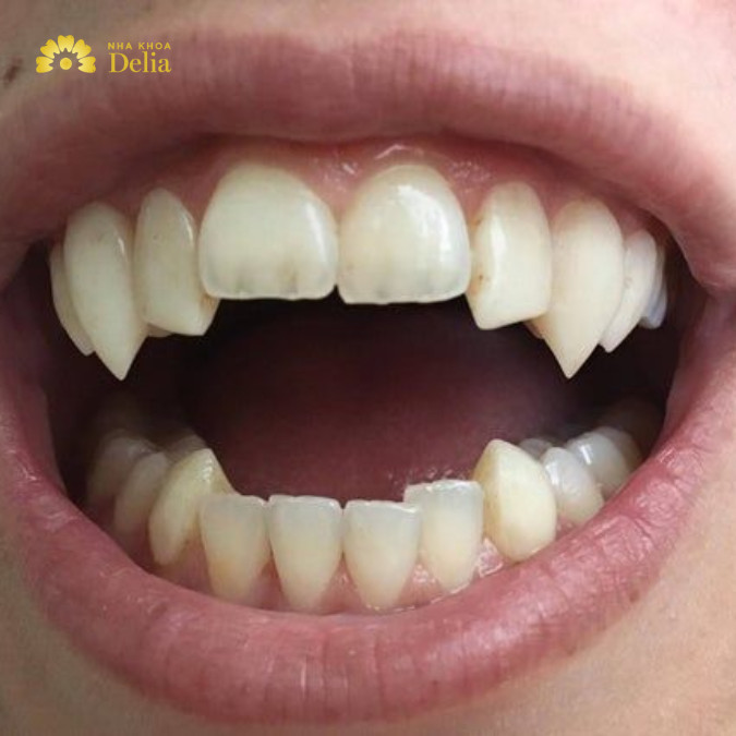 Răng chó ở người là như thế nào? Con gái có răng chó có sao không?