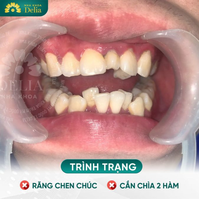 Thủ phạm khiến răng mọc lệch ra ngoài? Cách khắc phục hiệu quả