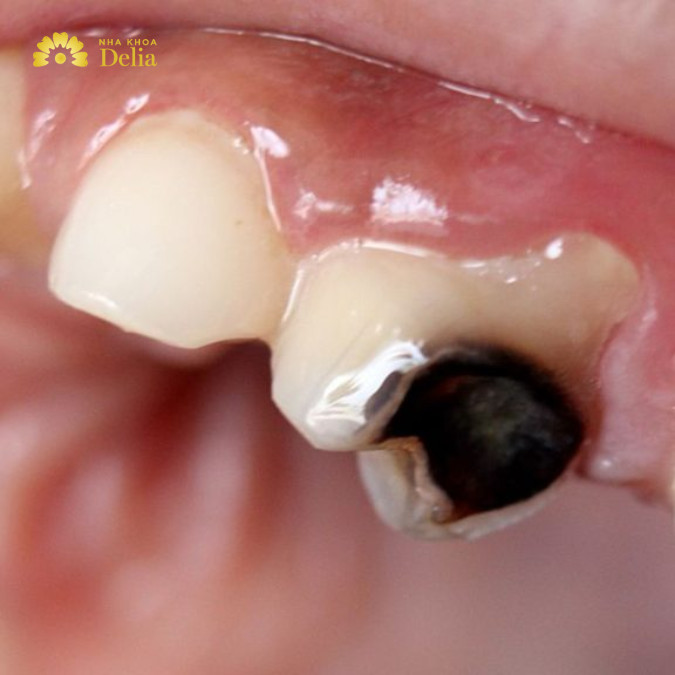 Răng sâu đen xì: Nguyên nhân và cách điều trị hiệu quả