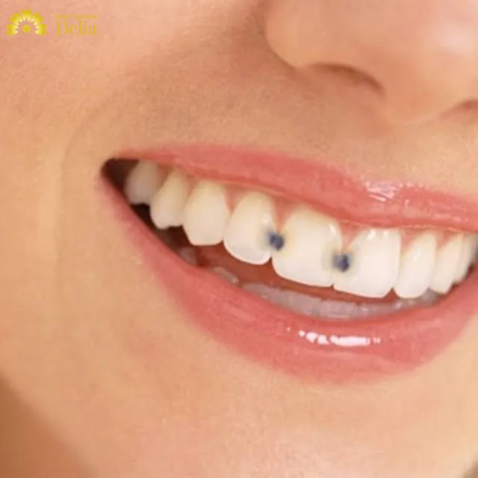 Cách chữa sâu kẽ răng tại nhà hiệu quả hay không? Giải pháp tốt nhất