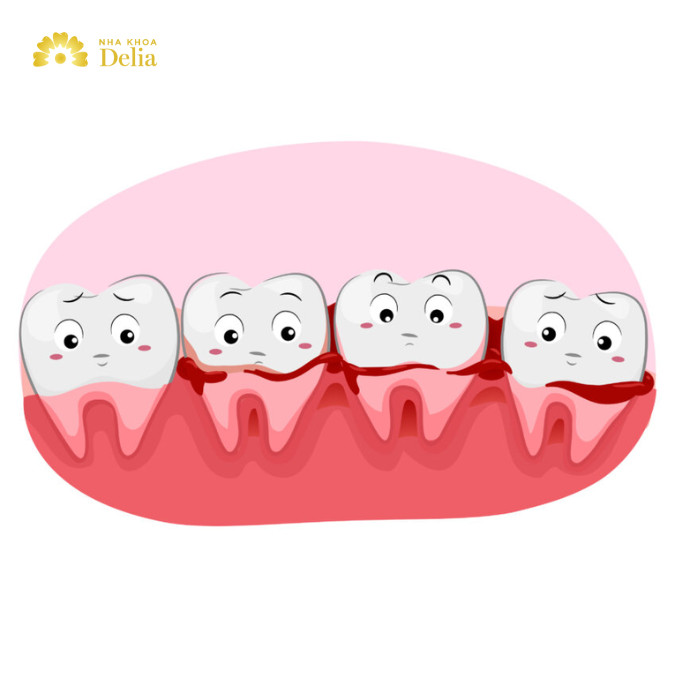 Sâu răng chảy máu có sao không, khắc phục như thế nào?
