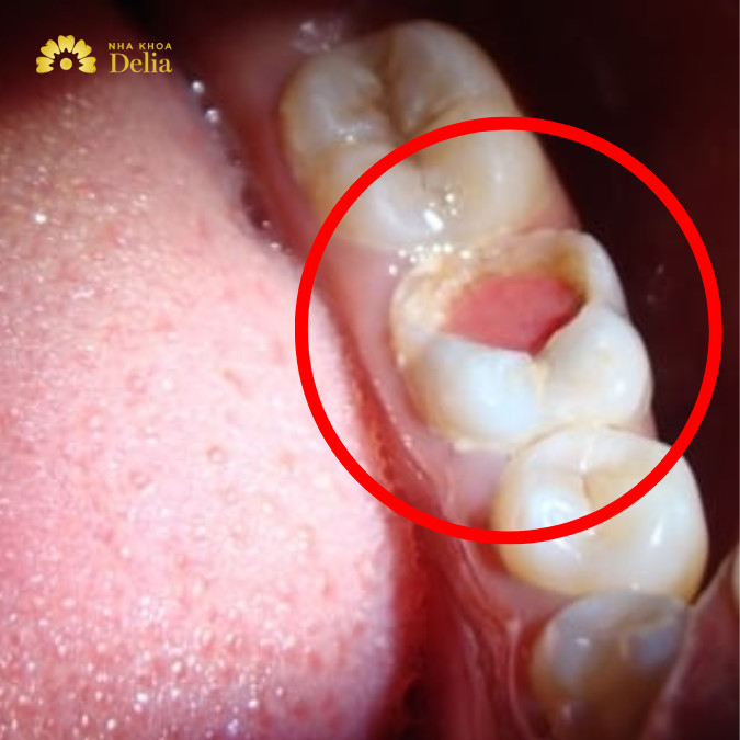 5 biến chứng nguy hiểm nhất của sâu răng lồi thịt