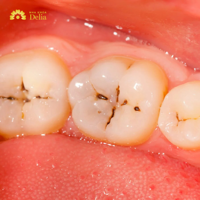 Sâu răng nhưng không đau – Nguy cơ tiềm ẩn của răng miệng