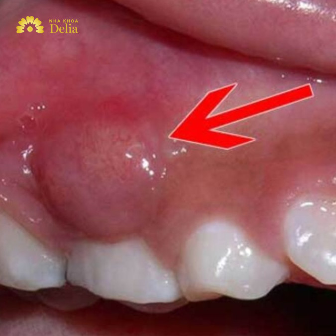 Sâu răng sưng lợi có nguy hiểm không, cách chữa sưng nướu?