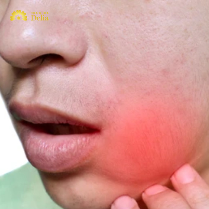 Sâu răng sưng má – Nguy hiểm tiềm ẩn, đừng chủ quan
