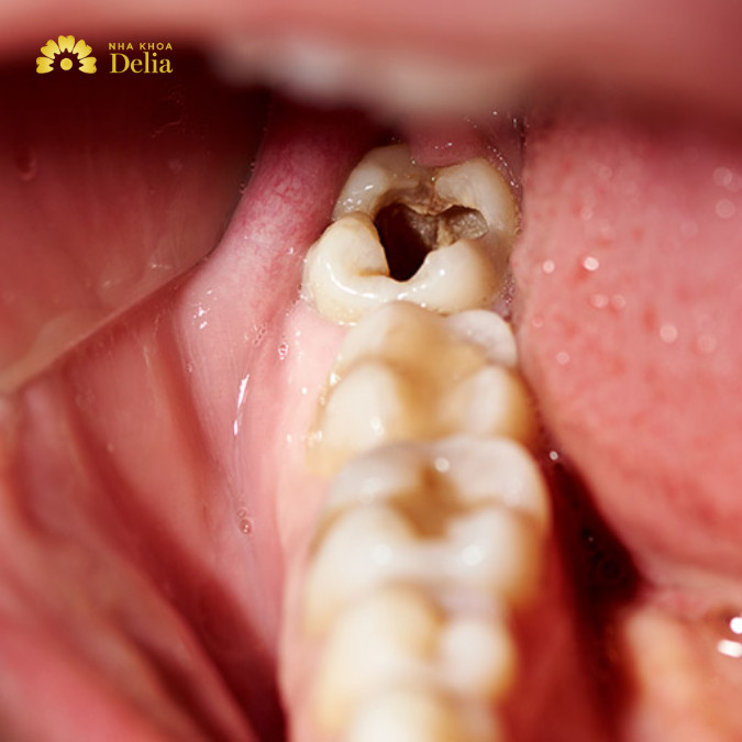 Sâu răng vào tủy nên nhổ hay giữ? Giải đáp chi tiết từ A đến Z