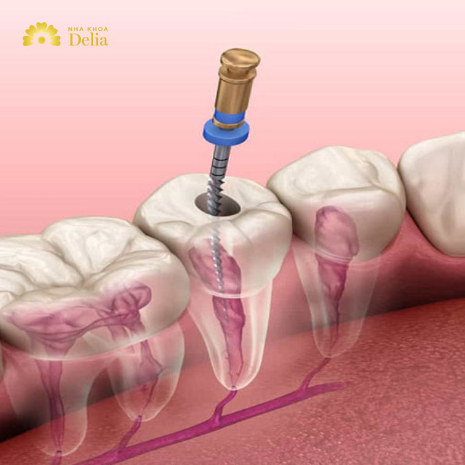 Tại sao phải lấy tủy răng? Lấy tủy răng để làm gì?