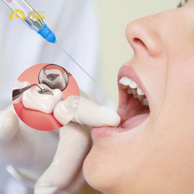 Trám răng có tiêm thuốc tê không? Giải đáp thắc mắc