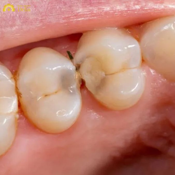 Dấu hiệu viêm kẽ răng là gì? Khắc phục kẽ răng viên như nào?