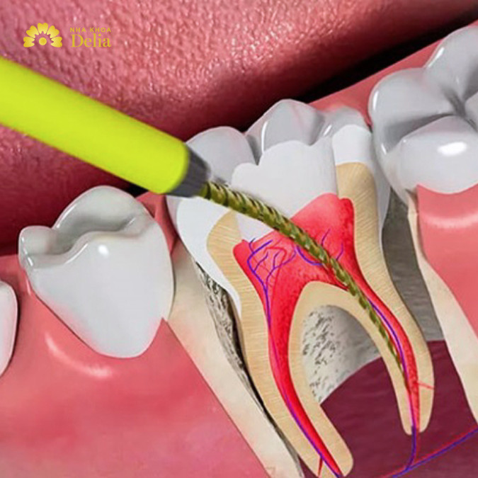 Viêm tủy răng có chữa được không, giải đáp từ A – Z