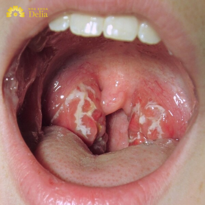 Nổi hạch ở quai hàm trái đau? Nguyên nhân do đâu cách điều trị?