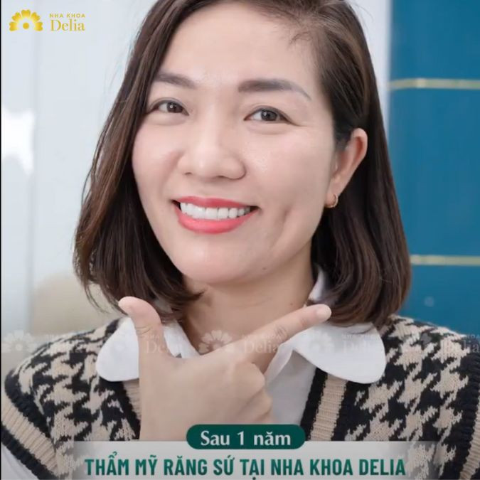 Đánh giá chất lượng răng sứ sau 1 năm sử dụng – chị Bích Hà