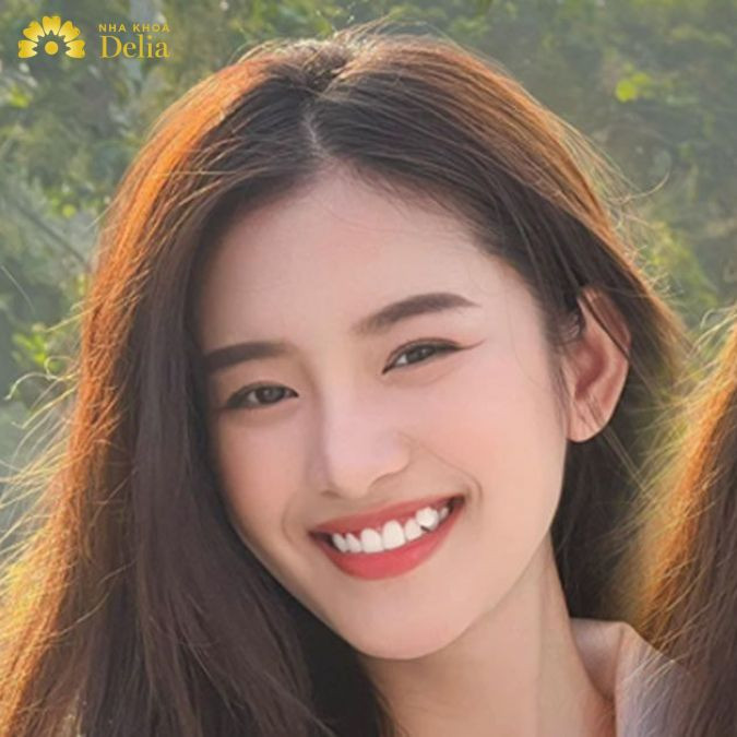 Khám phá 3 phương pháp đắp răng khểnh hiệu quả nhất