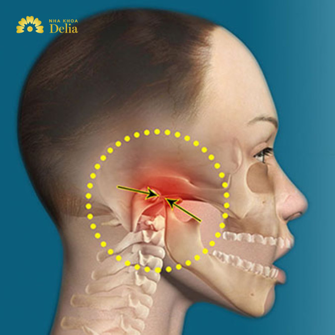5 cách đơn giản giúp giảm đau khớp thái dương hàm tại nhà