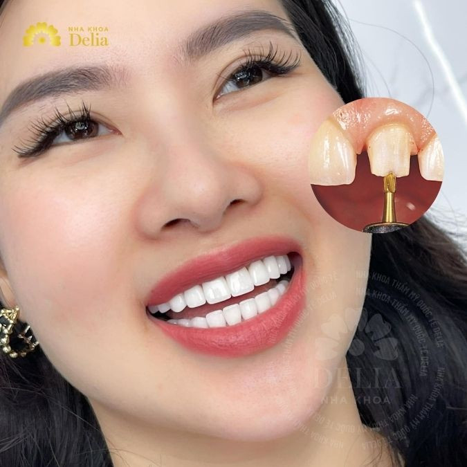 [TỔNG HỢP] 29+ Hình ảnh răng sau khi mài để bạn tham khảo