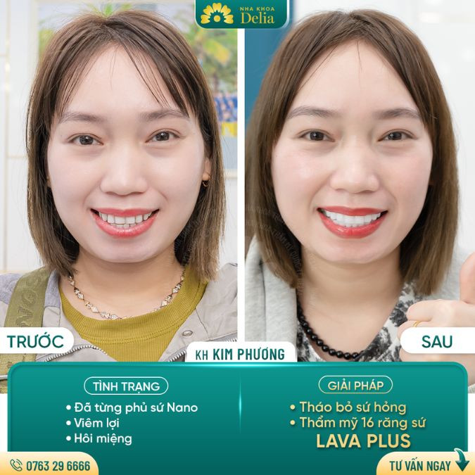 Feedback của chị Kim Phượng sau khi vượt ngàn cây số bọc răng sứ