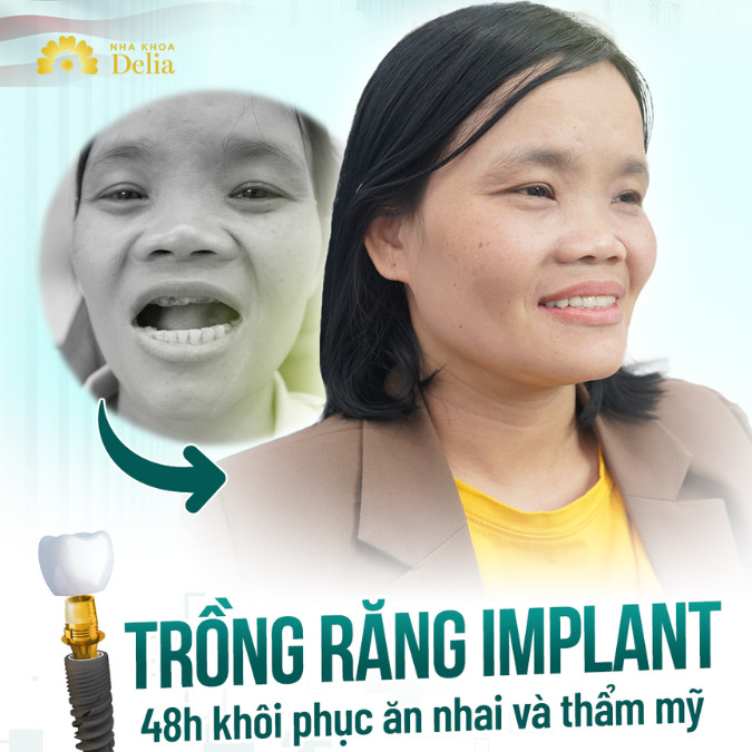 Làm gì khi gãy toàn bộ chân răng hàm trên – KH chị Lê Thị Quế