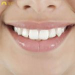 Một giải pháp khác và được đánh giá là hiệu quả vượt trội hơn hẳn đắp răng khểnh chính là làm răng khểnh bằng sứ