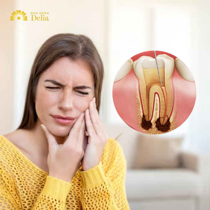 Lấy tủy răng xong vẫn đau? Lý giải nguyên nhân và cách xử lý