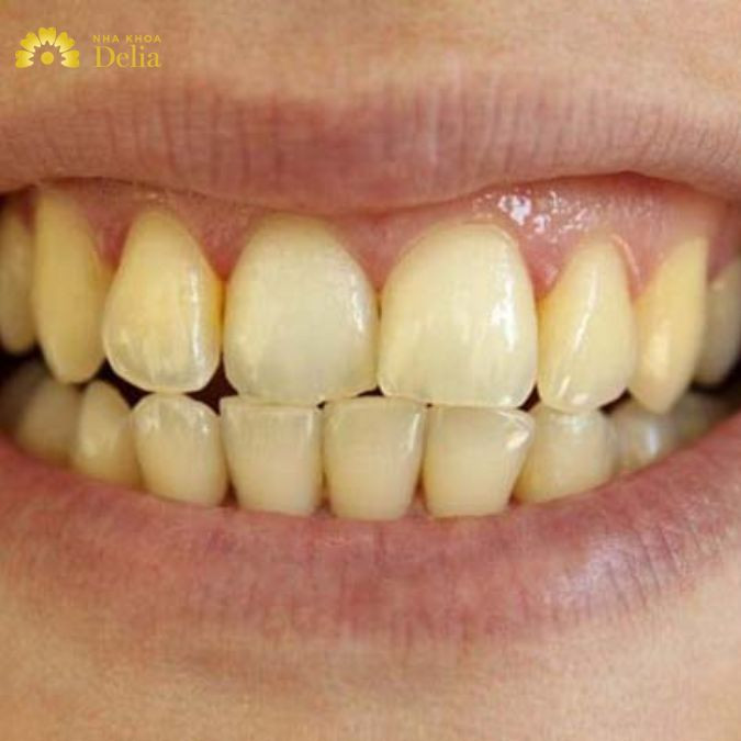 Mất men răng có thể tự phục hồi? Đâu là cách khắc phục tốt nhất?
