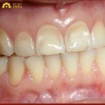 Khi men răng bị mòn, axit sẽ dễ dàng tấn công răng, dẫn đến sâu răng