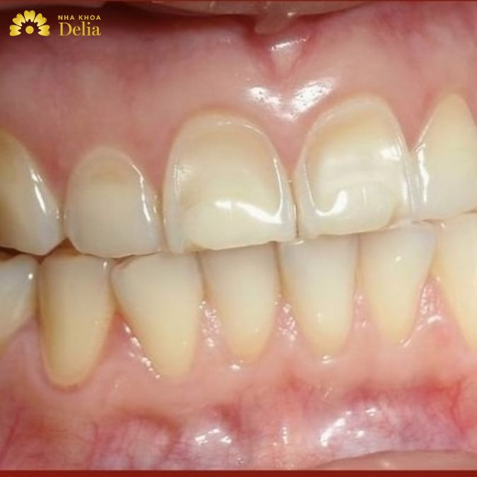 Mòn men răng: Nguyên nhân và cách khắc phục như nào?