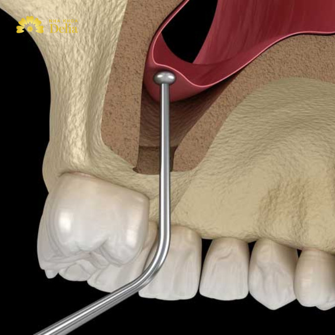 Nâng xoang: Giải pháp tối ưu cho cấy ghép Implant thành công