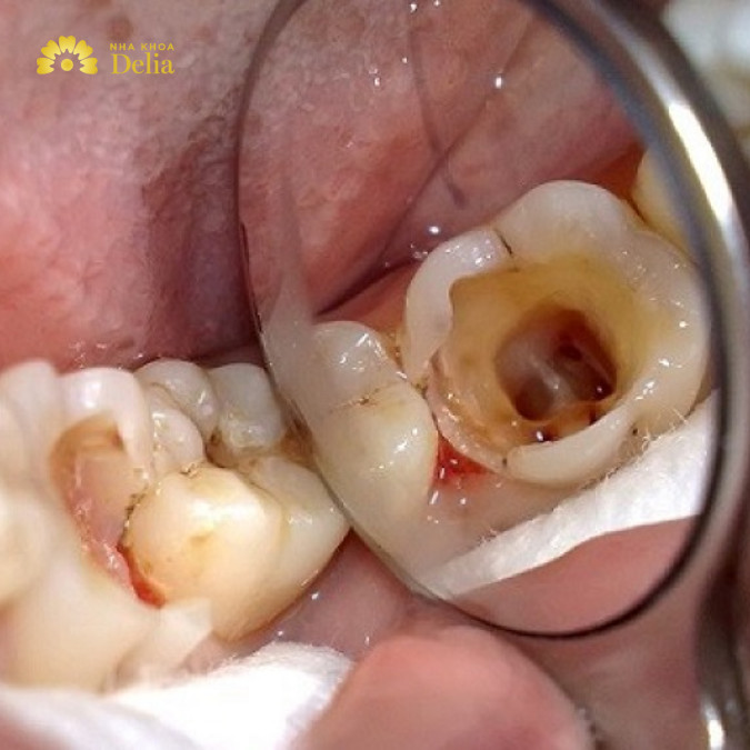 Nhổ răng cấm bị sâu có ảnh hưởng gì không? Chuyên gia tư vấn