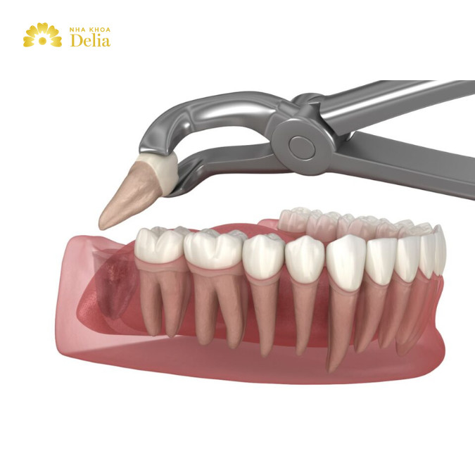 Nhổ răng số 8 bị sâu giá bao nhiêu? Nhổ răng ở đâu không đau?