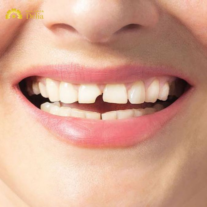 Phục hồi men răng được không? Phục hồi men răng như thế nào?