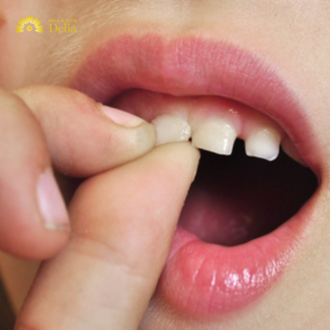 Răng cửa lung lay phải làm sao để chắc lại nhanh?