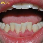 4 dấu hiệu răng khểnh hàm dưới