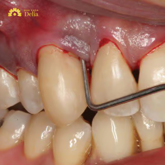 Răng lung lay do viêm nha chu phải làm sao, có hết được không?